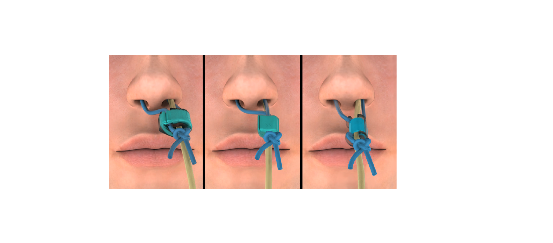 banner A alternativa confortável para fixação do tubo nasal